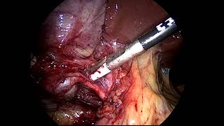 Difficult laparoscopic cholecystectomy in Plastered liver to Abdomen