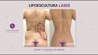 LIPOESCULTURA LÁSER - ANTES Y DESPUÉS | EXCELENTES RESULTADOS