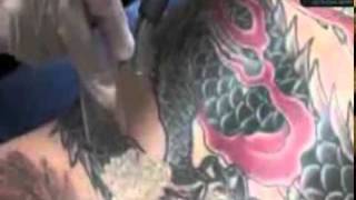 Tattoo Removal, Remove Tattoo, La Mesa, (877) 650-7267