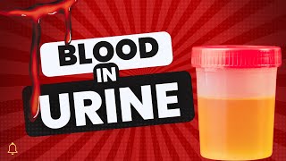 What Causes Blood in urine In Males? | Top 5 Causes For Hematuria