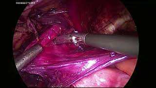 Laparoscopic Left Inguinal Hernia TAPP repair for Indirect sliding hernia with Ectopic Left kidney