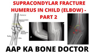 SUPRACONDYLAR FRACTURE HUMERUS IN A CHILD (ELBOW) - PART 2 -EPISODE 28