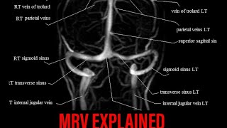 MRV Brain Explained in a Simple Way By Dr Saif U ddin (FCPS internal Medicine)