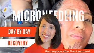 Microneedling Day by Day Recovery | Part 2 | Jonathan and Karen