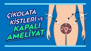 Endometriozis'te Kapalı Ameliyatın Avantajları - Çikolata Kistleri ve Laparoskopi