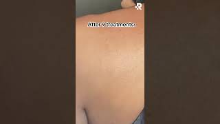 Before & After Tattoo Removal at Removery!🤩