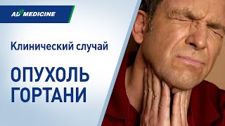 Опухоль гортани. Клинический случай