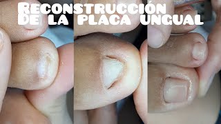 Como hacer Reconstrucción de la placa ungual con acrílico