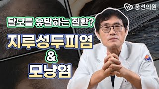 머리가 미칠듯이 가렵다면? - 탈모를 불러오는 지루성두피염 & 모낭염