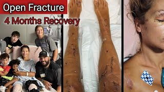 Open Fracture||Tibia Fibula Femur Fracture Recovery in 4 Months||99% bachne ka chance nahi tha ise