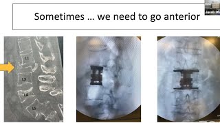 MIS Corpectomy for Thoracolumbar Fractures