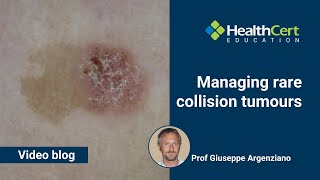 Managing rare collision tumours | Prof Giuseppe Argenziano