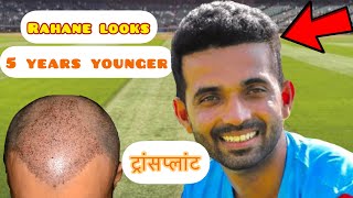 AJINKYA RAHANE| HAIR TRANSPLANT|CRICKETER|Hairfall|Minoxidil|Finasteride|Receding hairline|Results