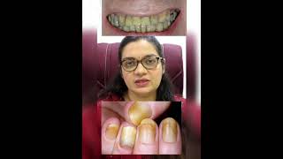 How Does Smoking Effect your Skin | Dermatology Answer | Dr. Dhanyata Ghubade