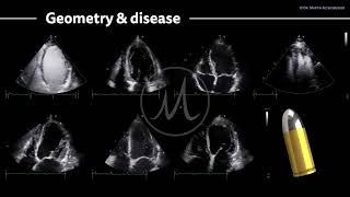 〖Echocardiography〗 The left ventricle - pathological examples