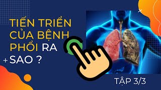 TIẾN TRIỂN & TIÊN LƯỢNG CỦA BỆNH VIÊM PHỔI RA SAO ? (TẬP 3/3) // Khí Công Nghiệp 263