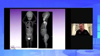 Achondroplasia - The Most Common Form of Dwarfism