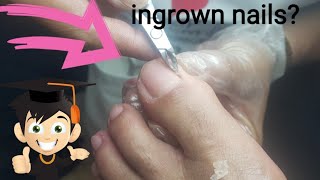 How to Remove ingrown Nails@Samar's Beauty Lounge