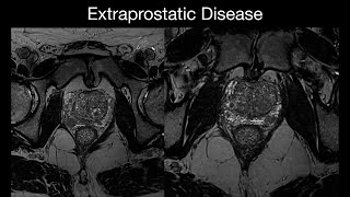 Extraprostatic Disease