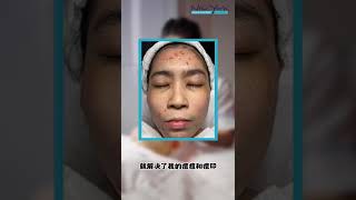 【顾客效果见证】3个月解决了严重痘痘问题！ | New York Skin Solutions 护肤专家| 专治各种肌肤问题：痘痘、黑斑、皱纹、敏感肌等等