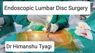 Endoscopic Spine Surgery (Lumbar disc prolapse operation/Slip Disc Surgery). Minimally invasive.