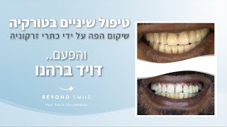 טיפולי שיניים בטורקיה עם ביונד סמייל - והפעם הוליווד סמייל מושלם של דויד ברהנו