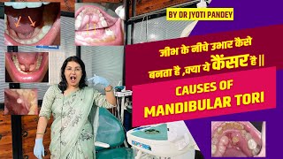 जीभ के नीचे उभार कैसे बनता है ,क्या ये कैंसर है || causes of MANDIBULAR TORI..