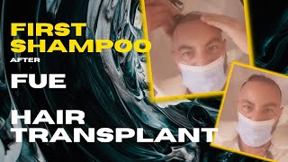 1st shampoo |  3 Days After | Hair Transplant | Enny Buono