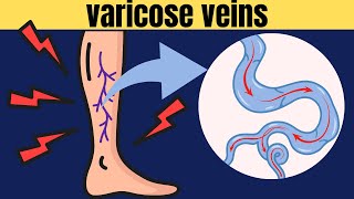 Varicose Veins- Risk Factors, Signs And Symptoms, Complications And Treatment