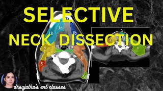 232.Selective Neck Dissection - structures removed #surgeryeducation #dentallectures