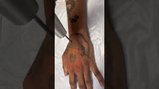 Scary skeleton tattoo on the hand, laser tattoo removal