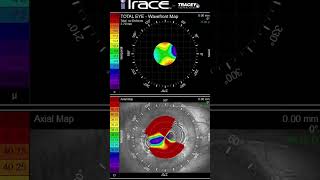 Radial Keratotomy with Over 12 Diopters of Irregular Astigmatism & the Daytona Race Track 🏎️