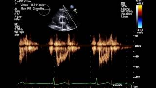 Normal Complete 2D Echocardiogram with Color Doppler and Spectral Doppler