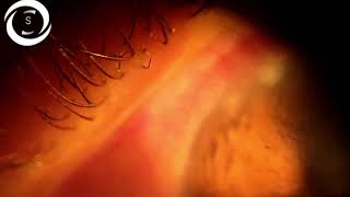 Ophthalmic Signs Cornea