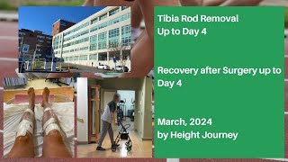 Tibia Rods Removal (Precice 2.2 Nails) - Up to Day 4 after Surgery