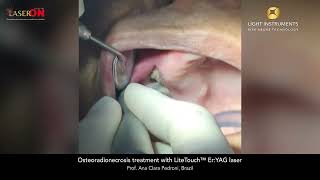 Osteoradionecrosis treatment with LiteTouch™ Er:YAG laser