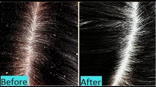 NATURAL HOME REMEDIES FOR DANDRUFF