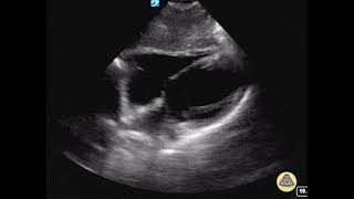 Normal Subxiphoid View