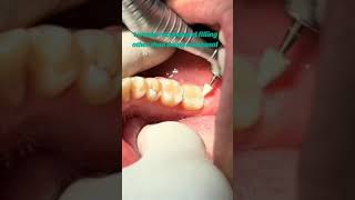 #Toothfiling#rootcanal#toothtreatment