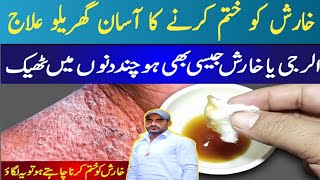 Kharish Khatam Karne Ka Tarika - Scabies Ka Ilaj In Urdu Itching Treatment - Kharish Ka Fori IlajLHC