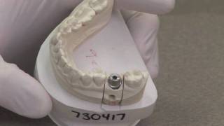 Dental Implants Explained