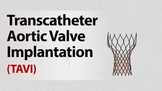 Transcatheter Aortic Valve Implantation TAVI