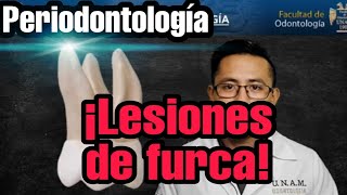 Lesiones de furcación y su tratamiento | periodontología