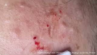 Big Cystic Acne Blackheads Extraction Blackheads & Milia, Whiteheads Removal Pimple Popping