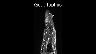 Gout Tophus