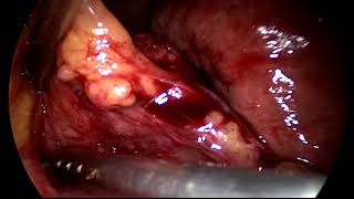 Laparoscopic CholecySTOTOMY for Empyema of Gall bladder