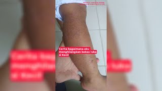 Cara Hilangkan Bekas Luka di Kaki Dengan Nubiko