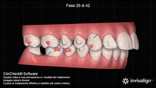 Invisalign