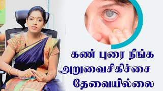 கண்புரை நீங்க அறுவைசிகிச்சை தேவை இல்லை  |kan purai tamil | cataract home remedies |இயற்கை மருத்துவம்