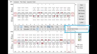 Complete Full Mouth Perio Charting